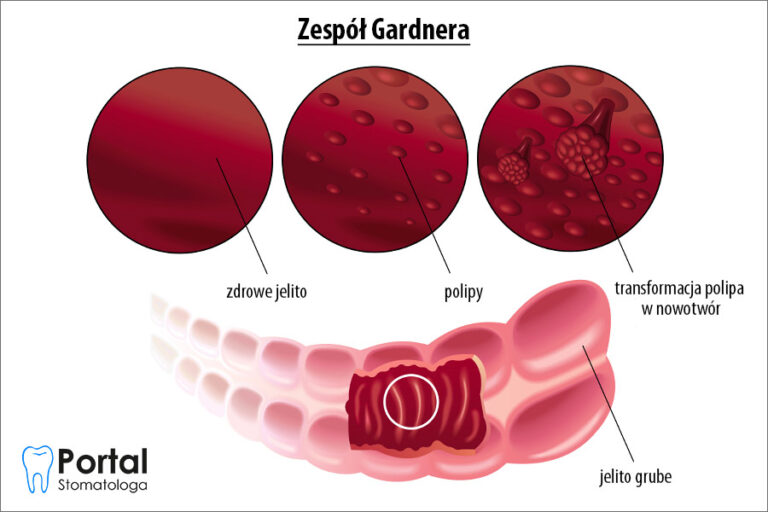 Zespół Gardnera Portal Stomatologa