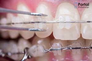 Aparat ortodontyczny estetyczny