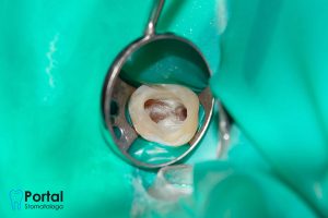 Leczenie kanałowe (leczenie endodontyczne)