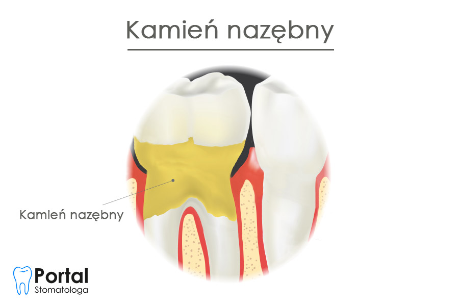 Kamień nazębny