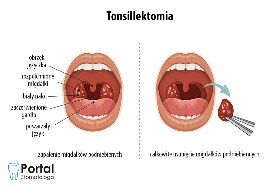 Tonsillektomia