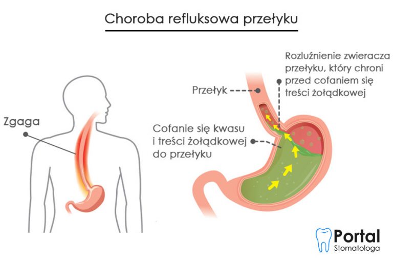 Choroba Refluksowa Portal Stomatologa 1712