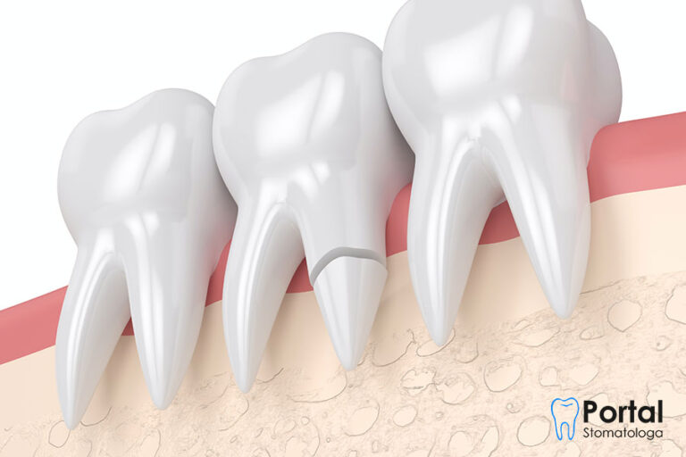 Złamanie korzenia zęba - Portal Stomatologa