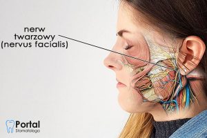 Porażenie nerwu twarzowego