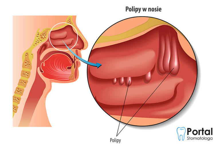 Polipy W Nosie Portal Stomatologa