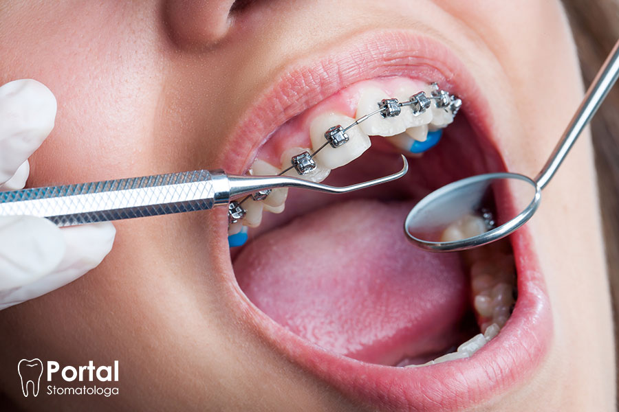 Etapy leczenia aparatem ortodontycznym