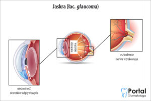 Jaskra (łac. glaucoma)