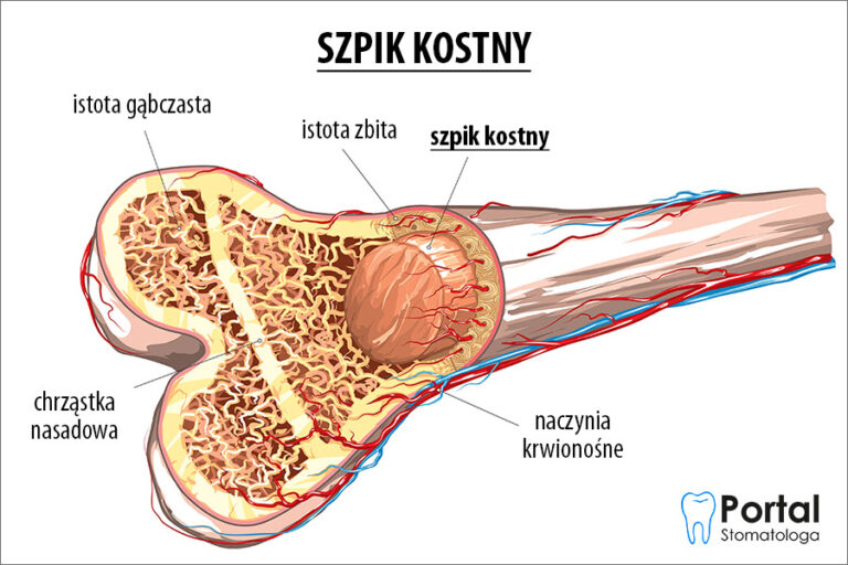 szpik-kostny-portal-stomatologa