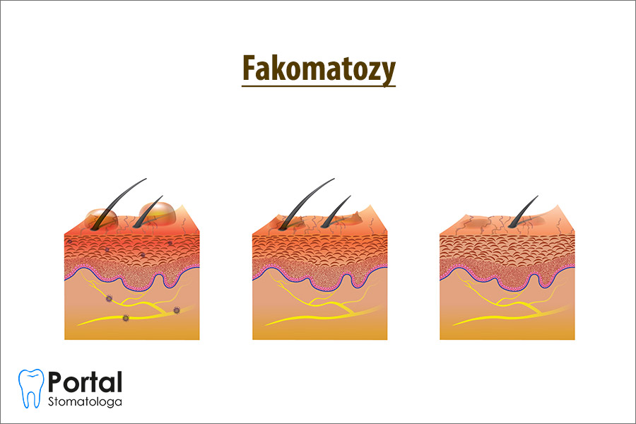 Fakomatozy