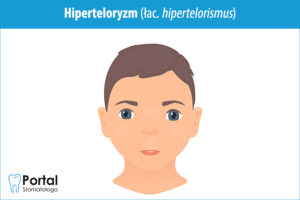 Hiperteloryzm (łac. hipertelorismus)