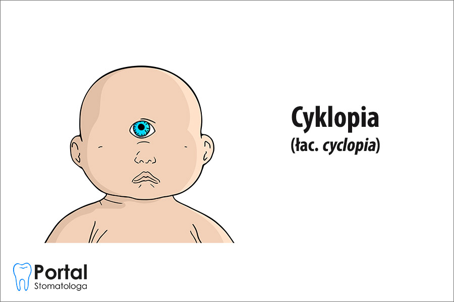 Cyklopia (łac. cyclopia)