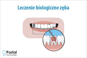 Leczenie biologiczne zęba