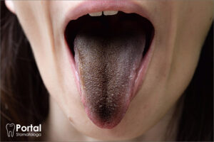 Czarny włochaty język