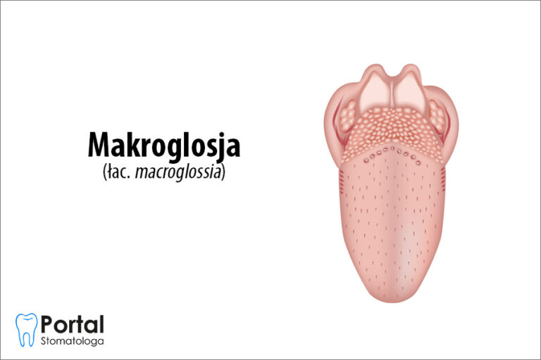 Makroglosja