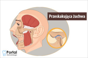 Przeskakująca żuchwa