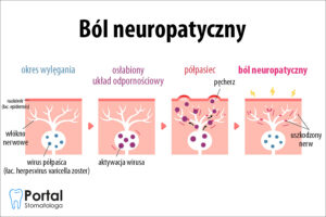 ból neuropatyczny