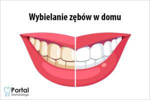 Wybielanie zębów w domu