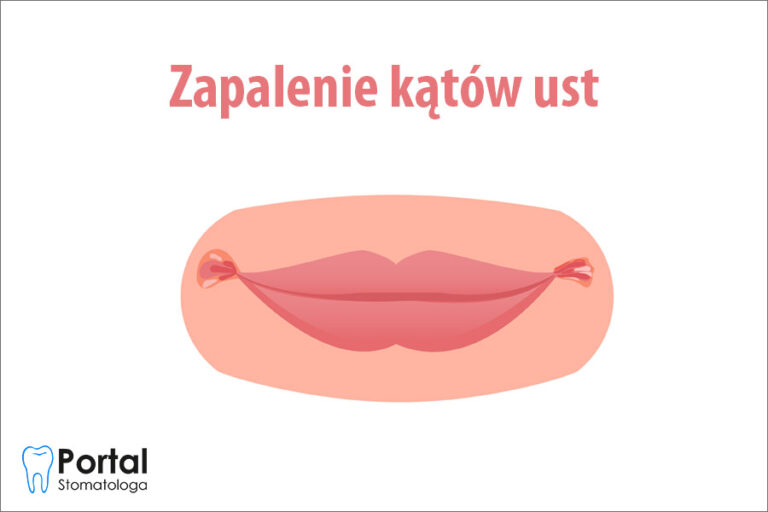 Zapalenie kątów ust - Portal Stomatologa