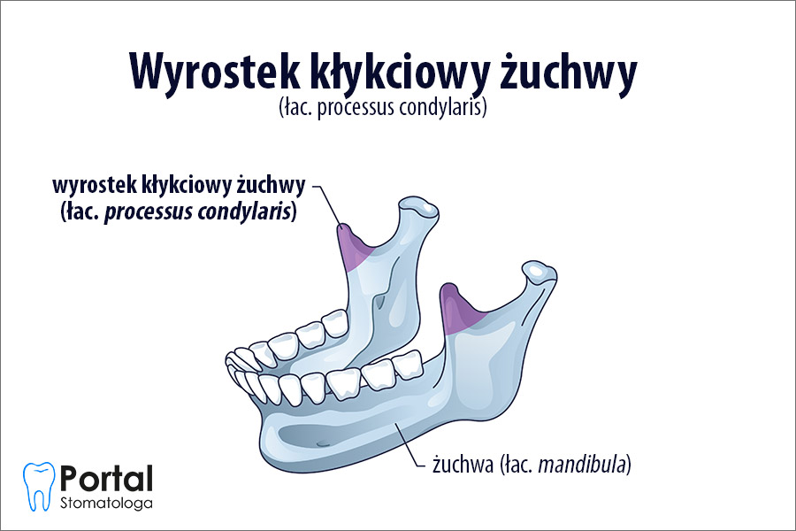 Wyrostek kłykciowy żuchwy