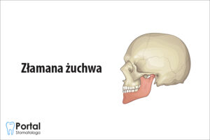 Złamana żuchwa