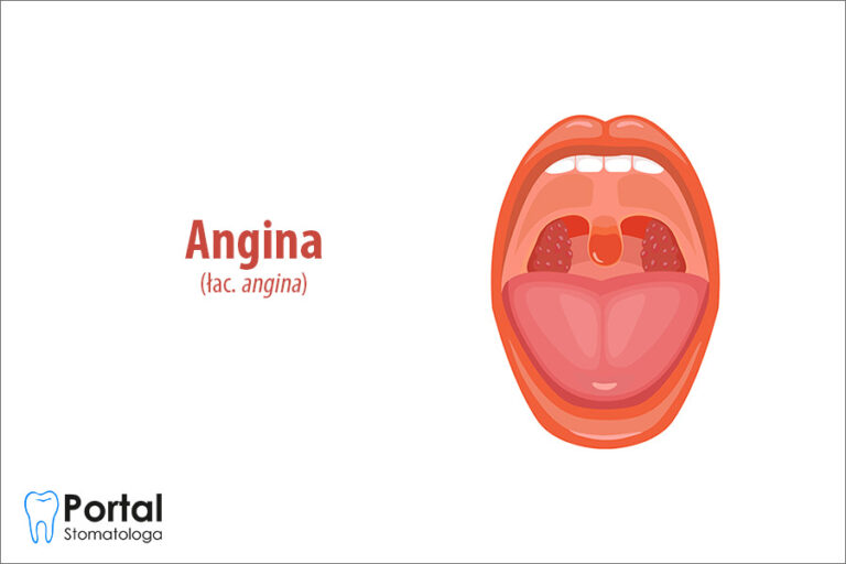 Angina