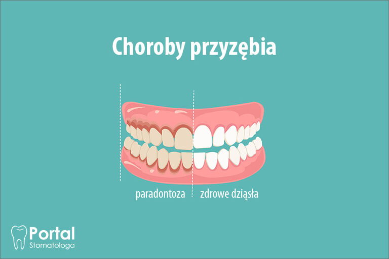 Choroby przyzębia