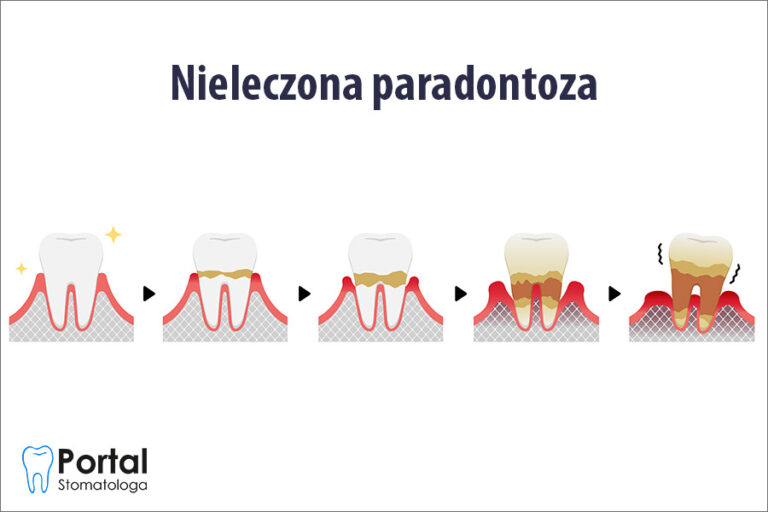 Nieleczona paradontoza