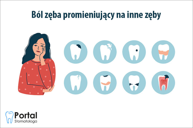 Ból zęba promieniujący na inne zęby