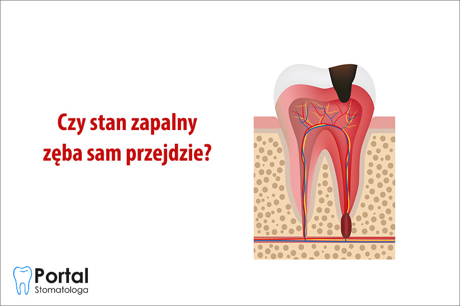 Czy stan zapalny zęba sam przejdzie?