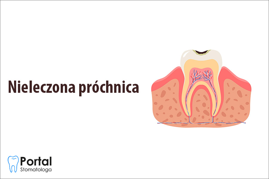 Nieleczona próchnica