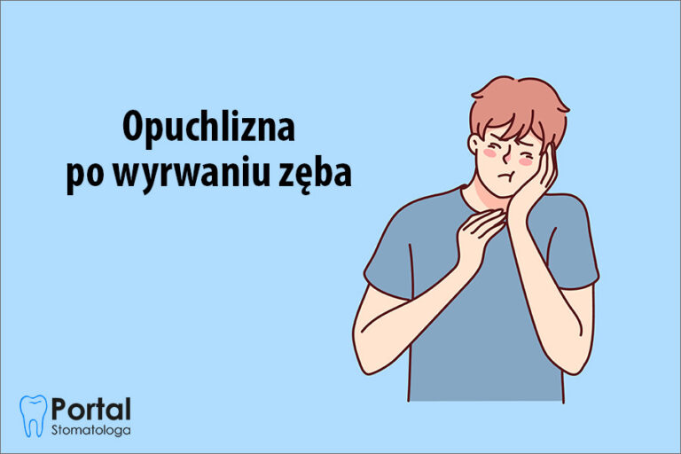 Opuchlizna po wyrwaniu zęba