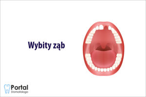 Wybity ząb