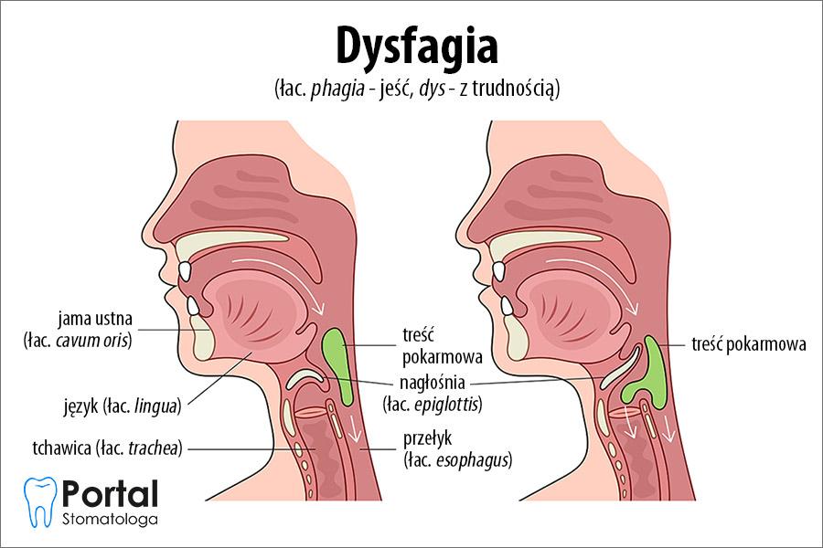 Dysfagia