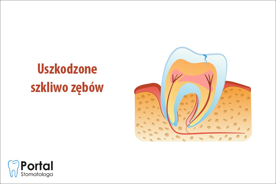 Uszkodzone szkliwo zębów