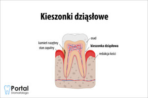 Kieszonki dziąsłowe