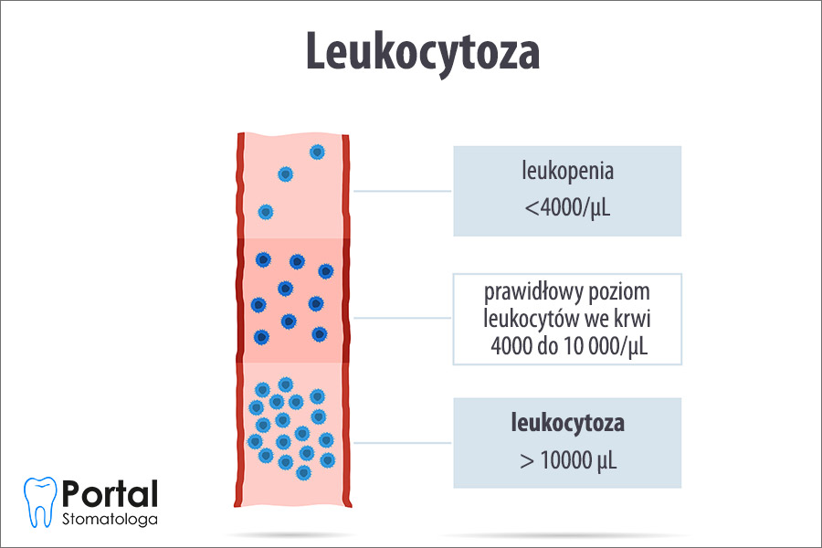 Leukocytoza