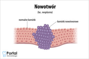 Nowotwór