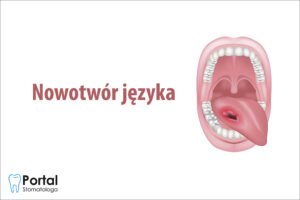 Nowotwór języka