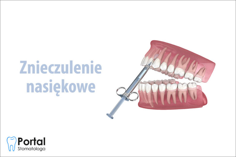 Znieczulenie nasiękowe