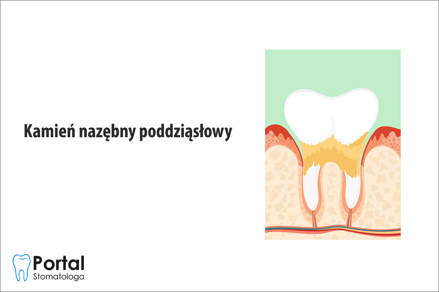 Kamień nazębny poddziąsłowy