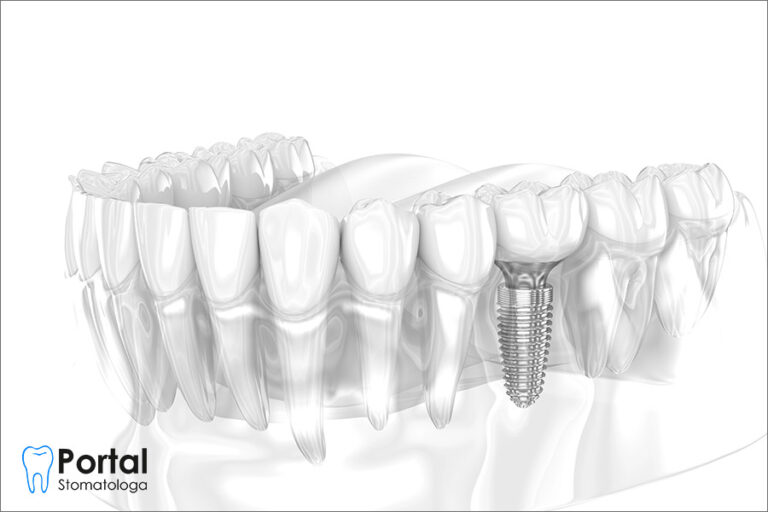 Implanty ceramiczne