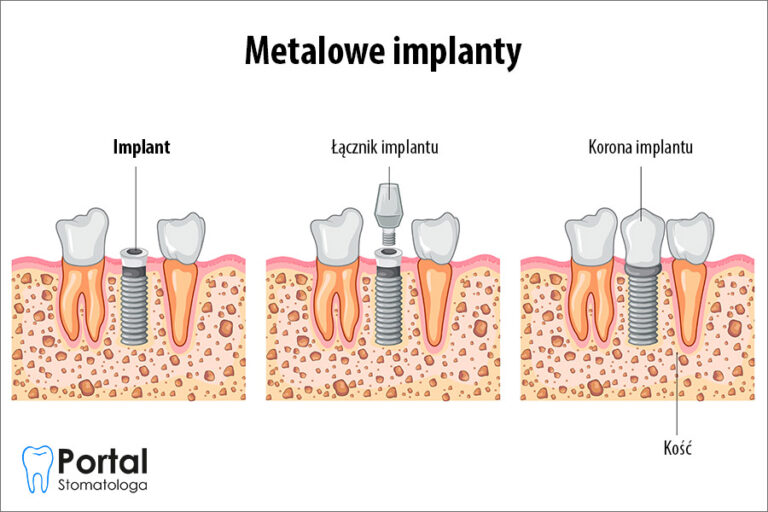 Metalowe implanty