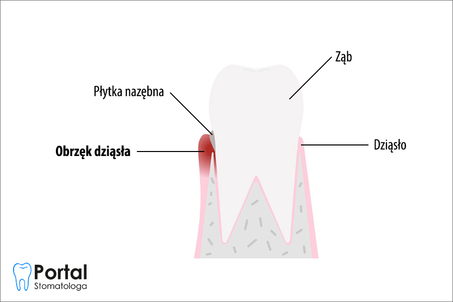Obrzęk dziąsła