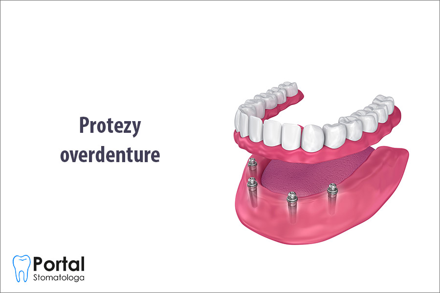 Protezy overdenture