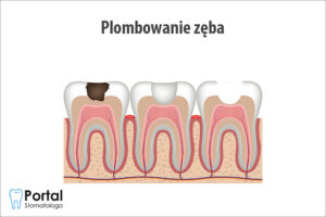Plombowanie zęba