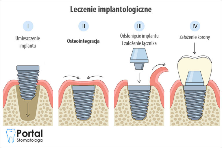 Osteointegracja