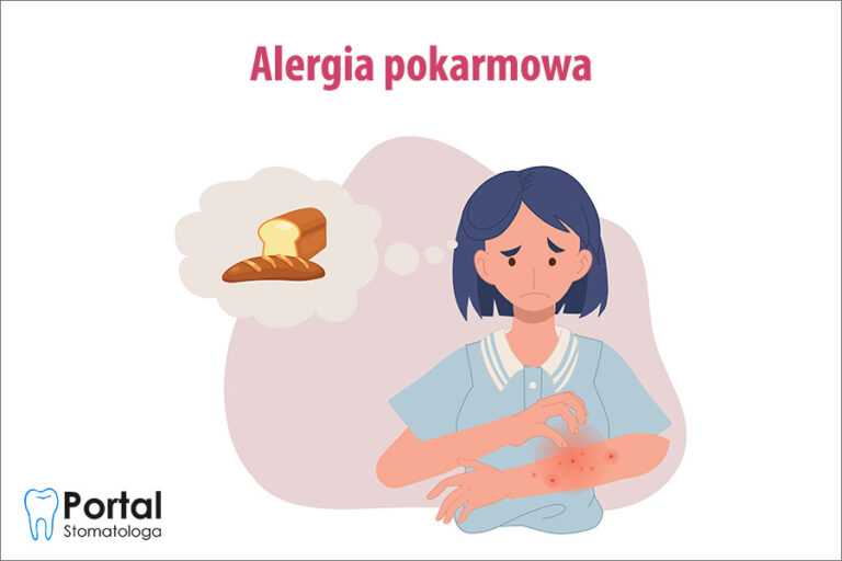 Alergia pokarmowa