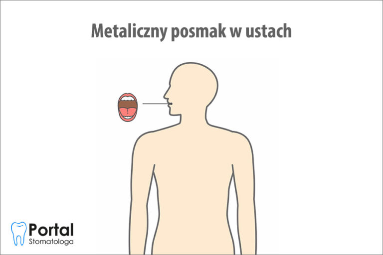 Metaliczny posmak w ustach