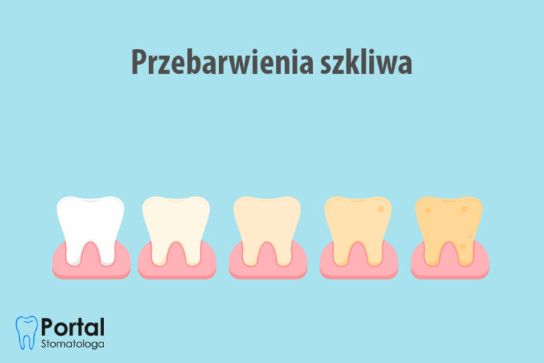 Przebarwienia szkliwa