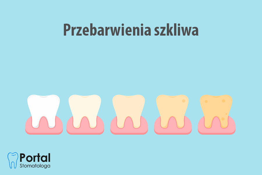 Przebarwienia szkliwa